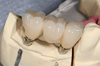 Dental Bridges