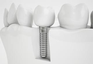 Granbury Dental Implants