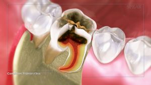 dental crown healing video