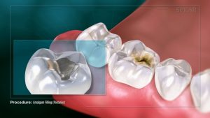 cracked and chipped teeth fillings with almalgam