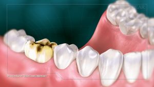 non digital impressions for porcelin and composite crowns