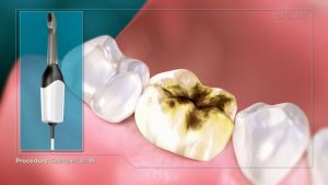 digitally manufactured crowns in Granbury TX - video showing crown implant process