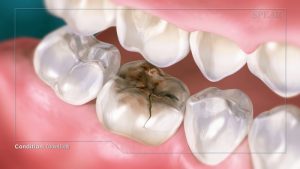 cracked tooth repair instructional video