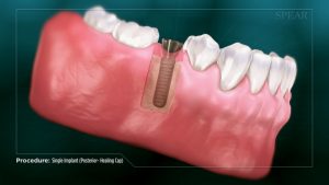 single dental implant cap video