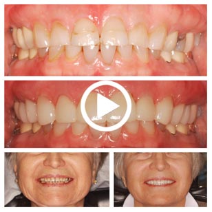 Same day Crown, Dental Veneers, at our dental office in Granbury, Texas