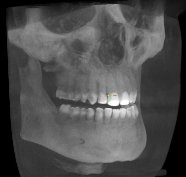 CBCT 3D dental xrays