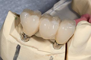 Granbury dental bridges