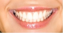 dental filling and bonding
