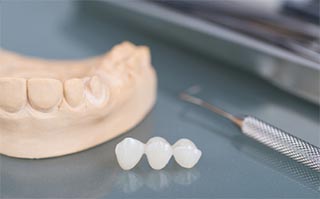 dental inlays and onlays